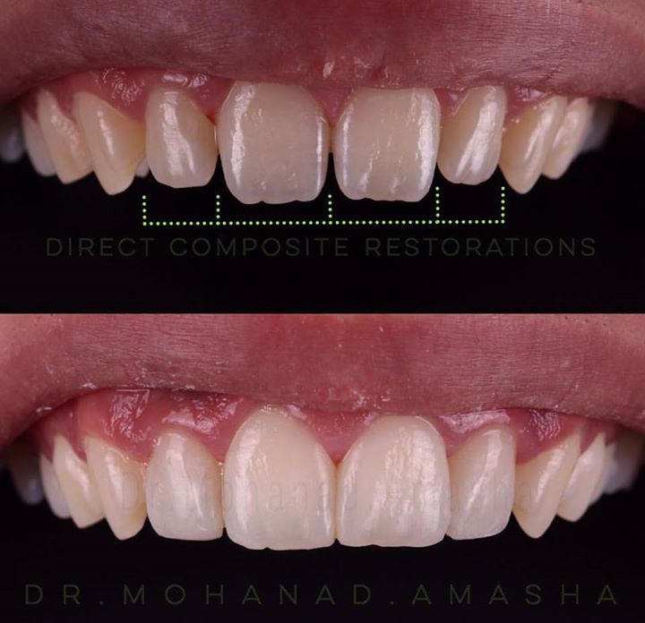 Aesthetic Restorations On The 4 Anterior Teeth Without Any Tooth ...