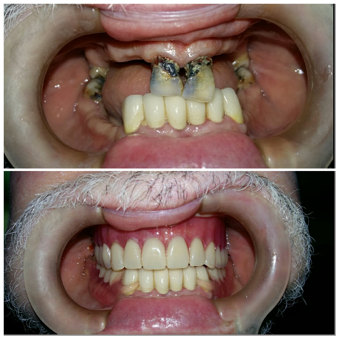 immediate partial dentures